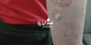 "مصاب
      بمرض
      جلدي
      نادر"
      ..
      عائلة
      شاب
      أردني
      تناشد:
      "أنقذوا
      ابننا
      من ألمٍ لا يرحم" - شوف 360 الإخباري