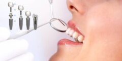 أفضل أطباء زراعة الأسنان بالكويت – موقع كيف