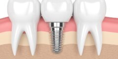 أفضل أطباء زراعة الأسنان في الدمام – موقع كيف