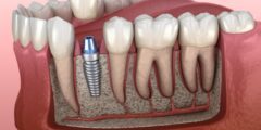 أفضل أطباء زراعة الأسنان في جدة – موقع كيف