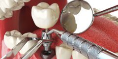أشهر أطباء زراعة الأسنان بسلطنة عمان – موقع كيف