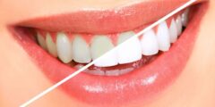 أفضل أطباء تجميل الأسنان بالشارقة – موقع كيف