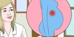 التهاب الزائدة الدودية أثناء الحمل – موقع كيف