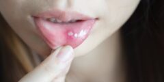 علاج فطريات الفم من الصيدلية – موقع كيف