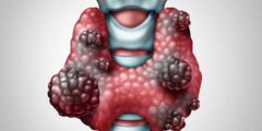 ما هو العقيدات الدرقية Thyroid Nodules – موقع كيف
